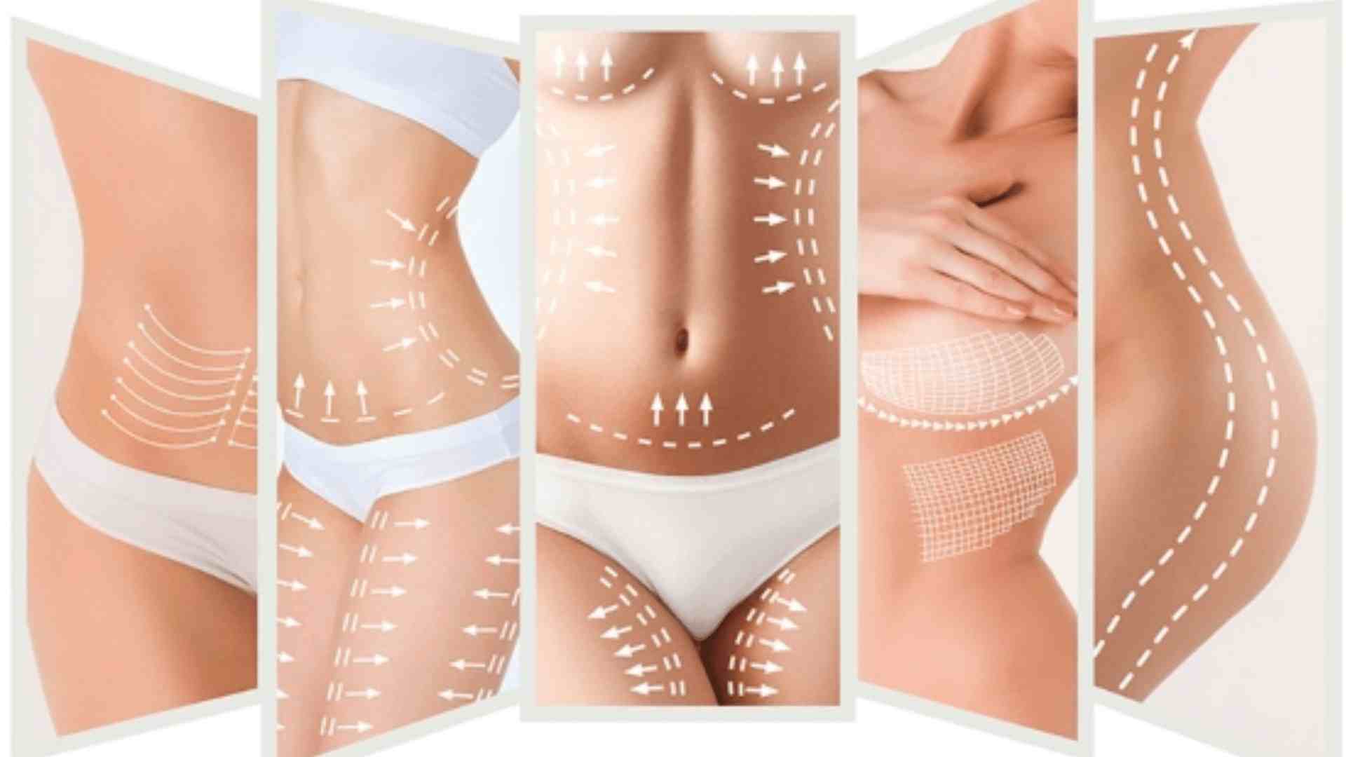 Heykeltıraş Sistemi (Body Sculpting)