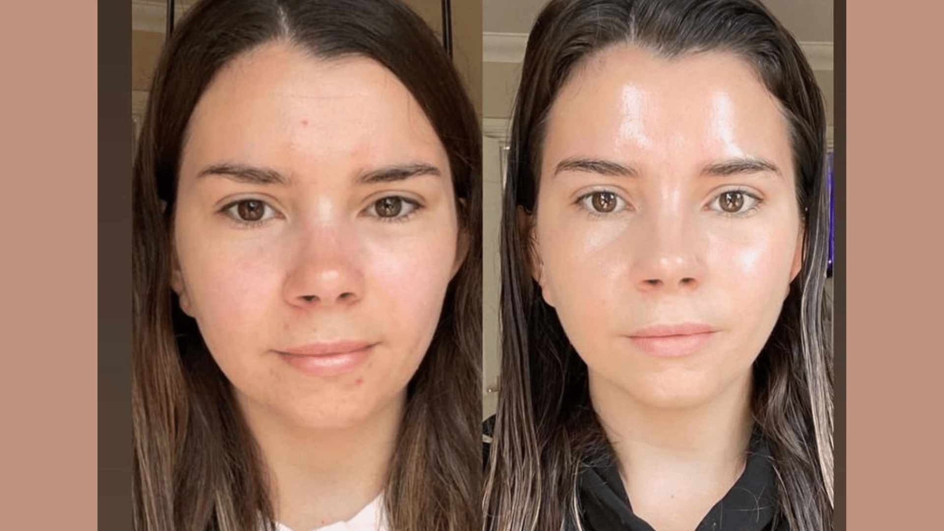Paris Işıltısı (Mezolift – Cilt Vitamin Aşısı)